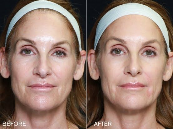 Patient before and after Farmington Renuva treatment.