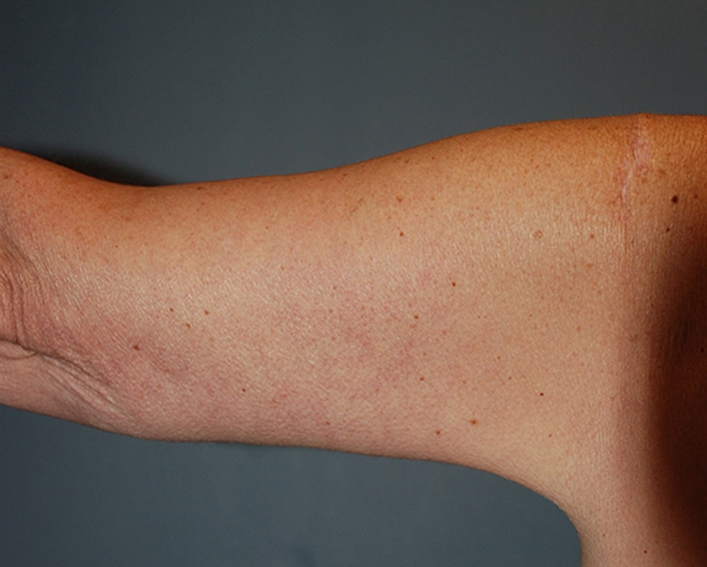 Brachioplasty Patrick Felice Before & After