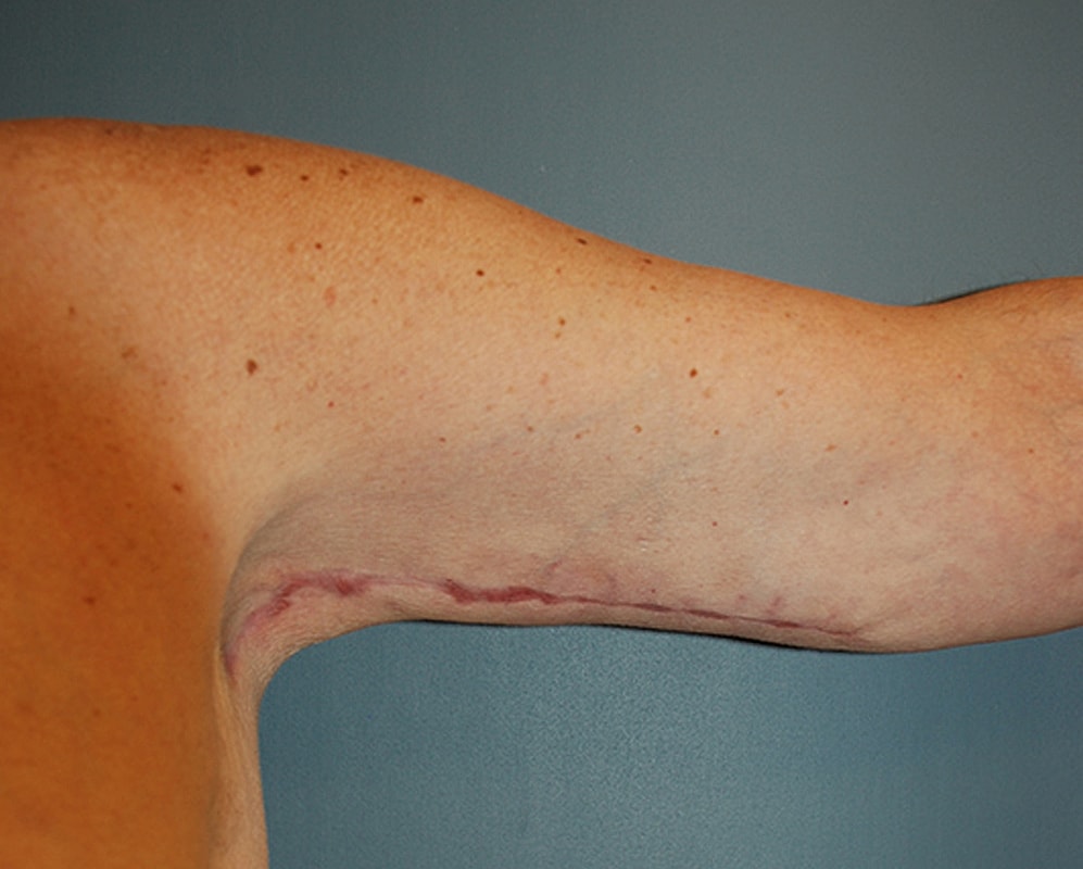Brachioplasty Patrick Felice Before & After