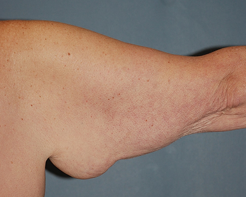 Brachioplasty Patrick Felice Before & After