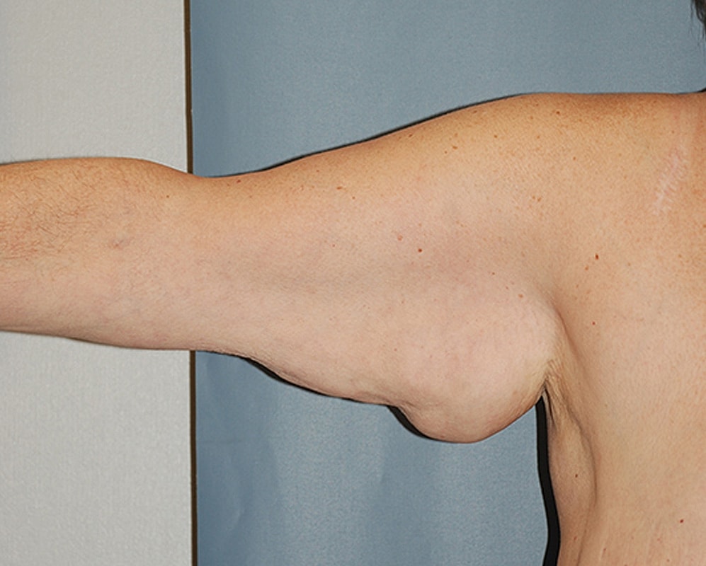 Brachioplasty Patrick Felice Before & After
