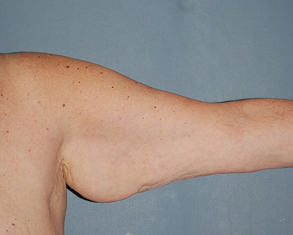 Brachioplasty Patrick Felice Before & After