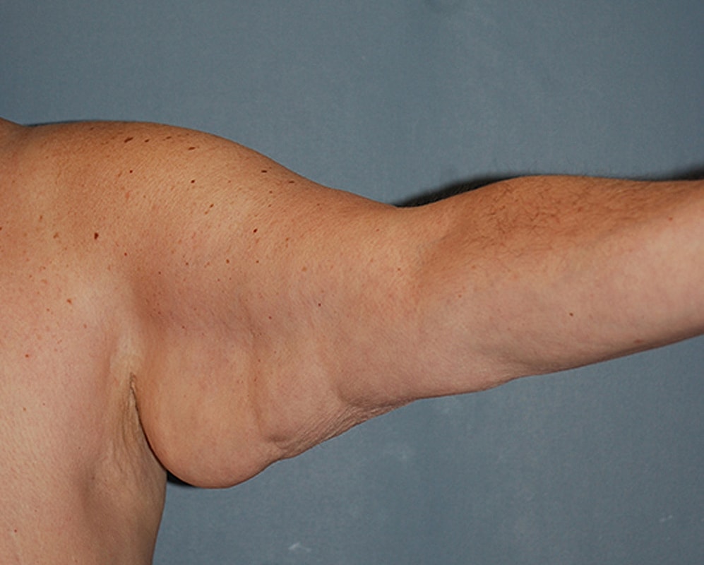 Brachioplasty Patrick Felice Before & After