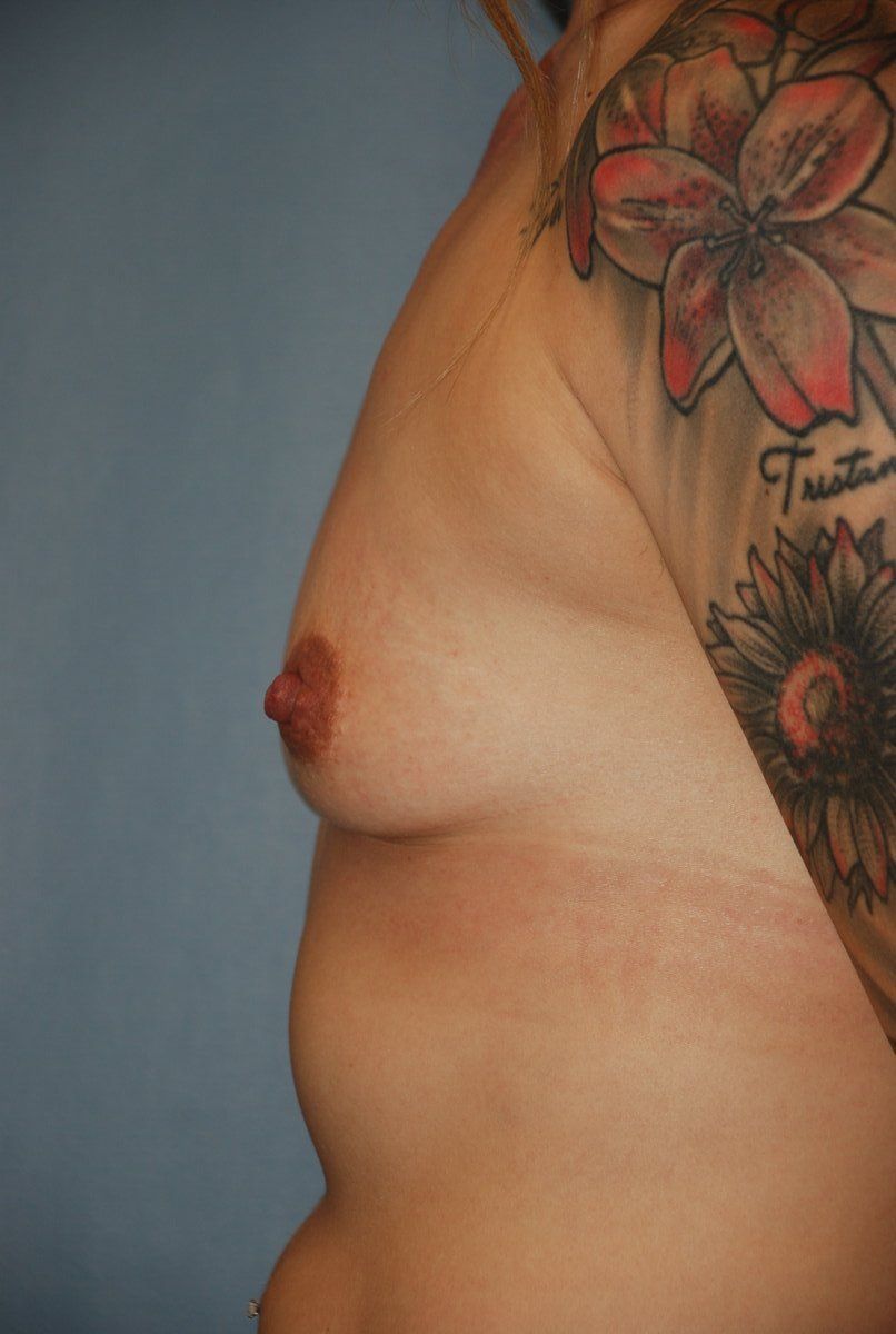 Breast Augmentation Patrick Felice Before & After
