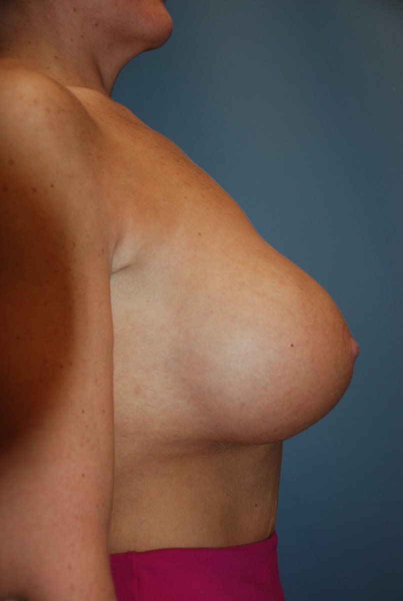 Breast Augmentation Patrick Felice Before & After