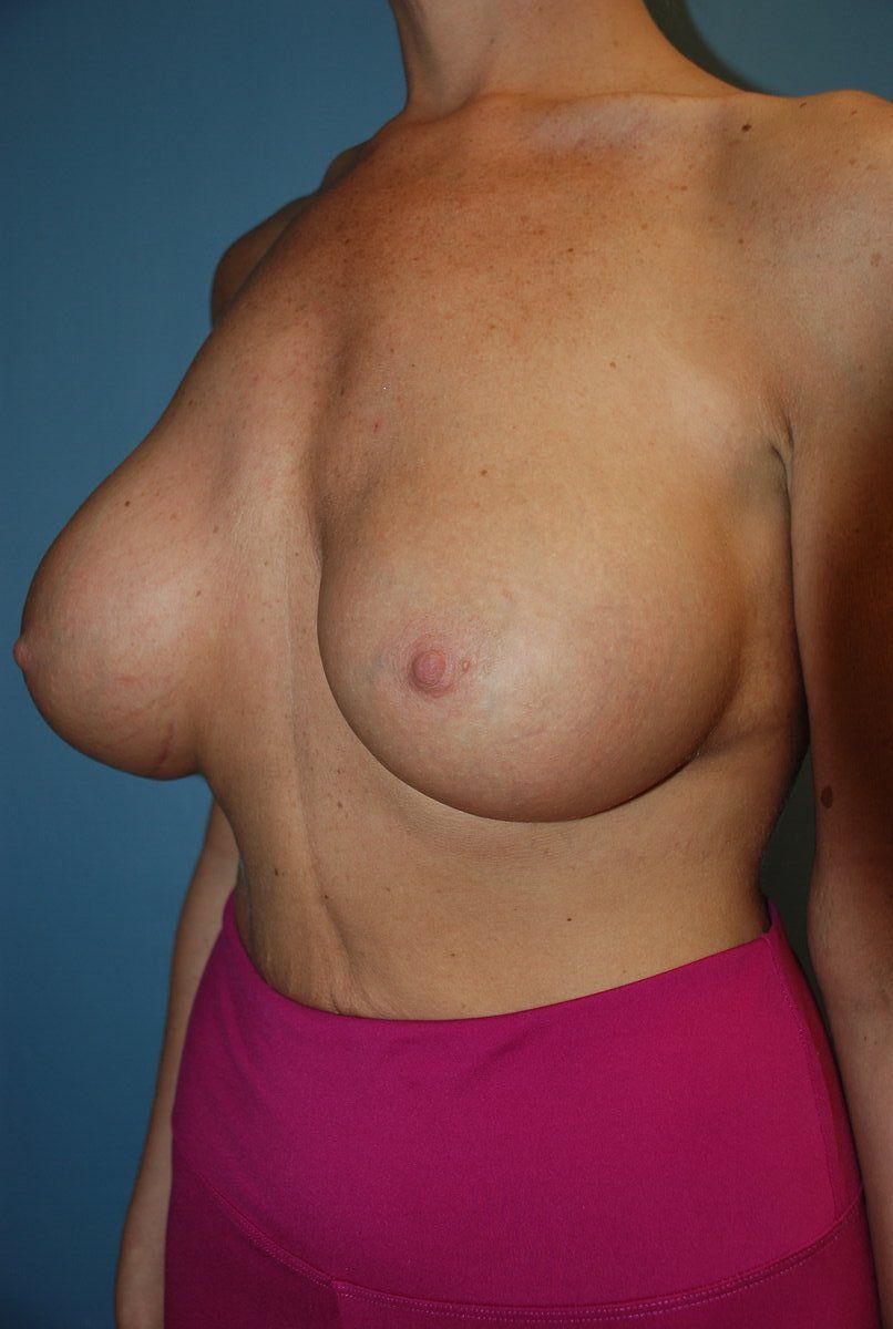 Breast Augmentation Patrick Felice Before & After
