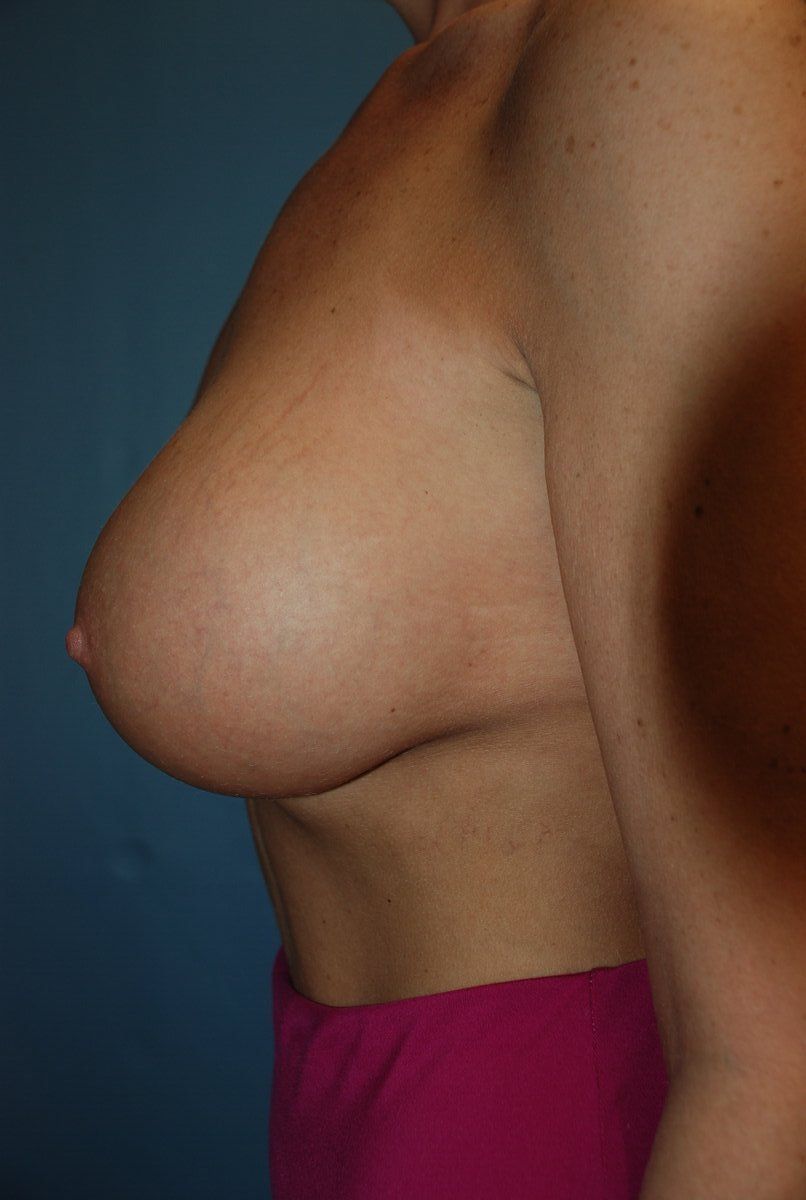 Breast Augmentation Patrick Felice Before & After