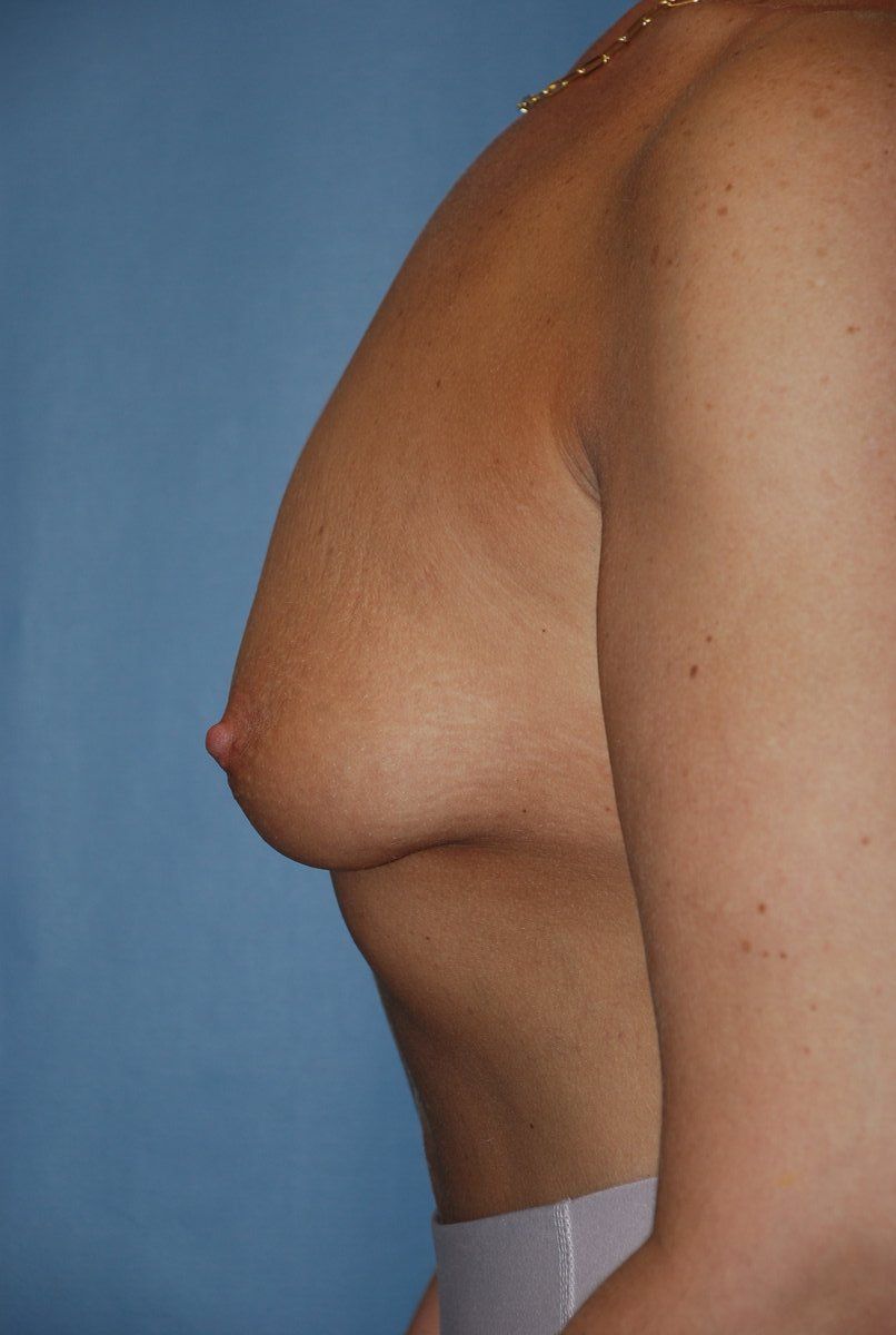 Breast Augmentation Patrick Felice Before & After