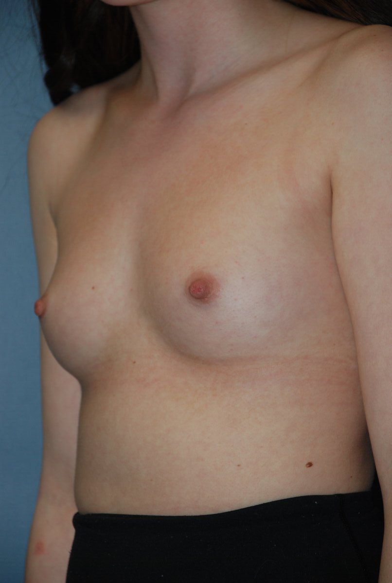 Breast Augmentation Patrick Felice Before & After