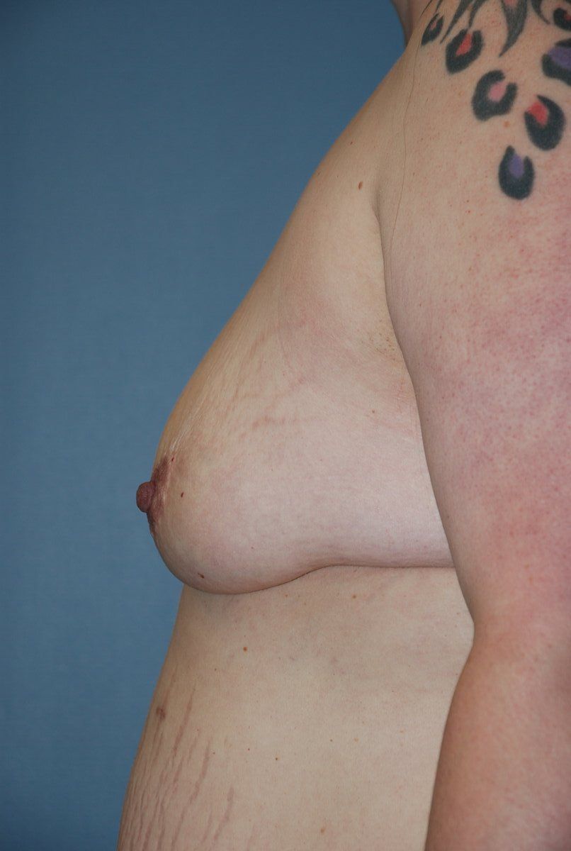 Breast Augmentation Patrick Felice Before & After