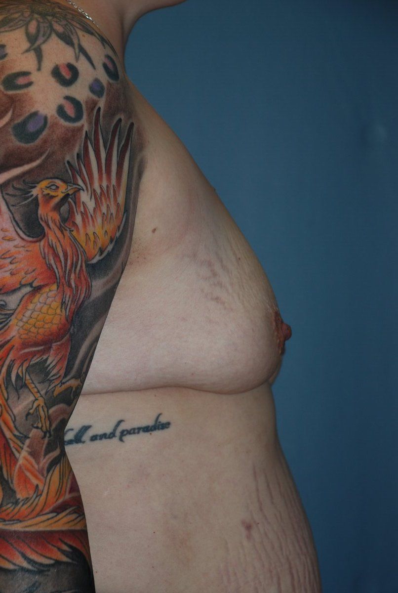 Breast Augmentation Patrick Felice Before & After