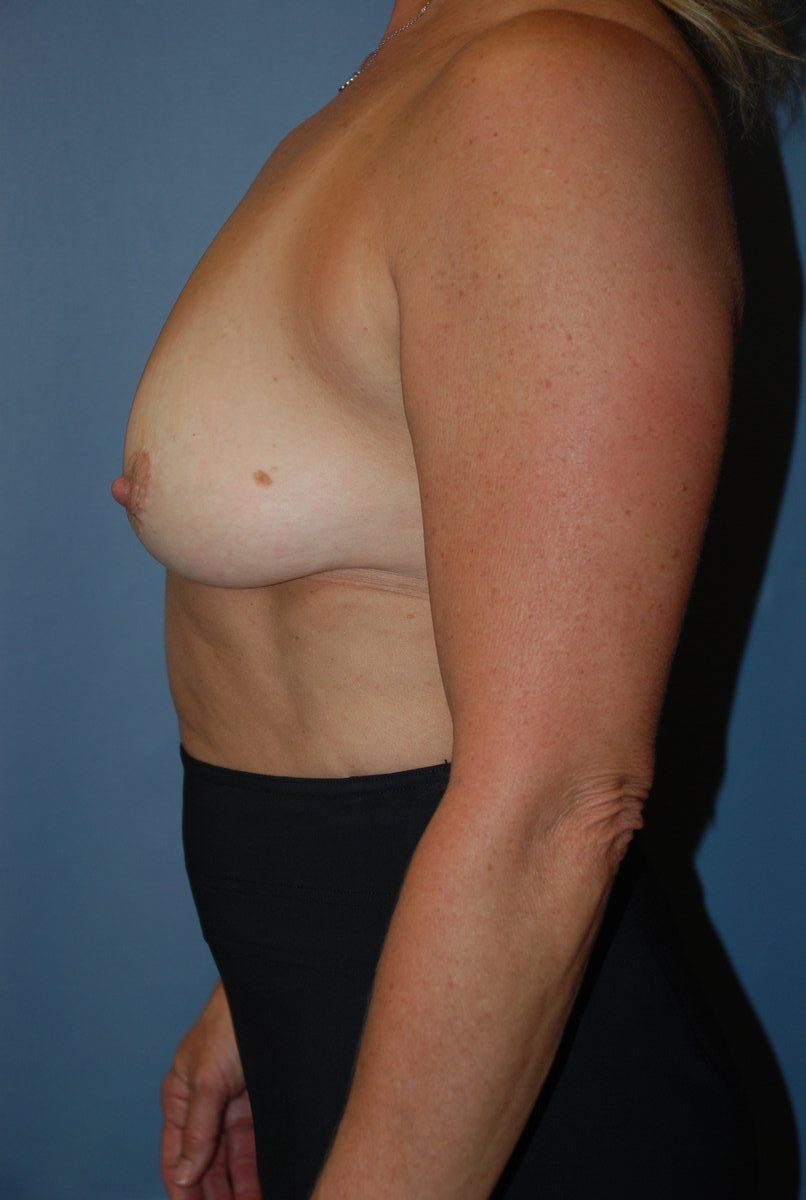 Breast Augmentation Patrick Felice Before & After