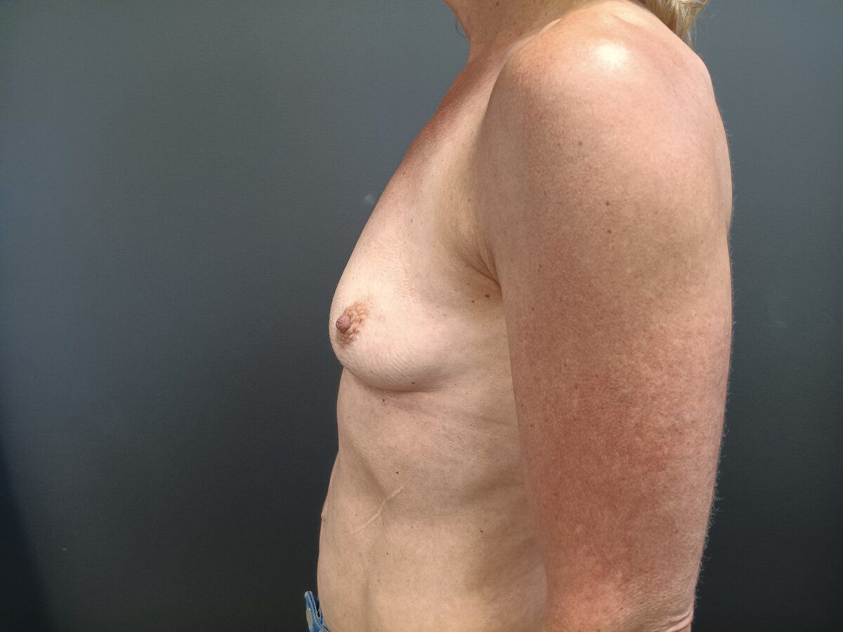 Breast Augmentation Patrick Felice Before & After