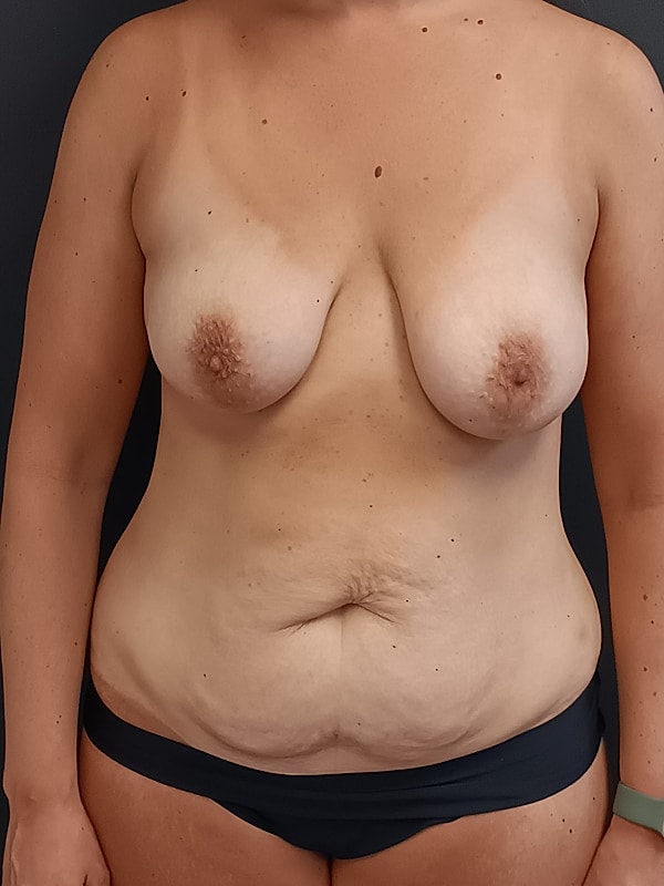 Abdominoplasty Patrick Felice Before & After