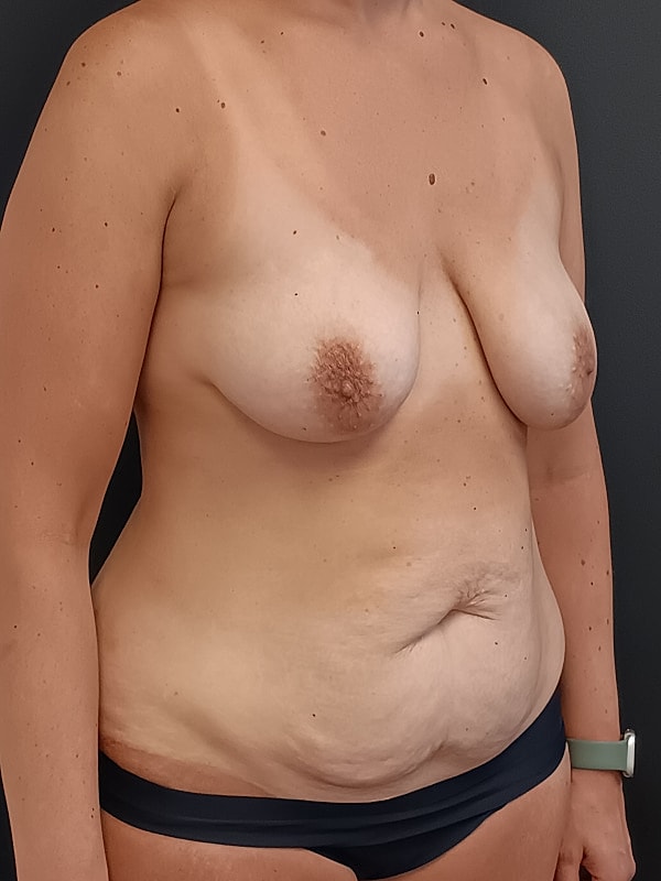 Abdominoplasty Patrick Felice Before & After