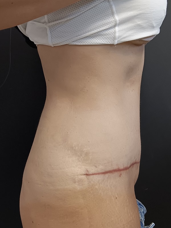 Abdominoplasty Patrick Felice Before & After