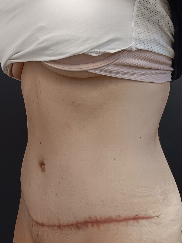 Abdominoplasty Patrick Felice Before & After