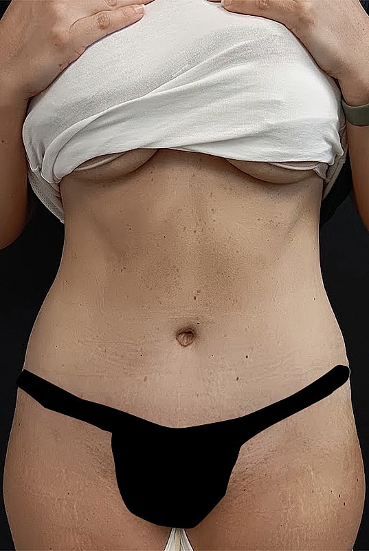 Abdominoplasty Patrick Felice Before & After