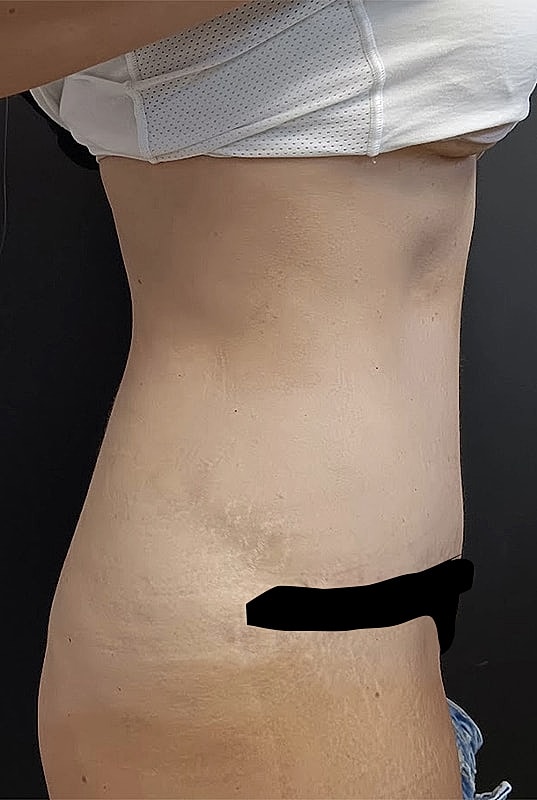 Abdominoplasty Patrick Felice Before & After