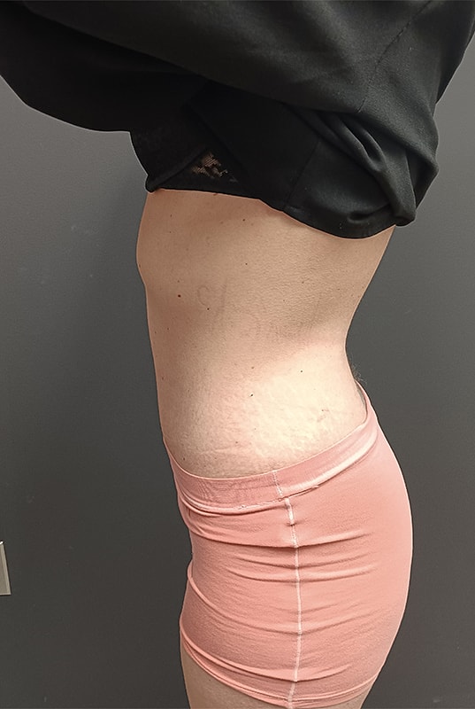 Abdominoplasty Patrick Felice Before & After