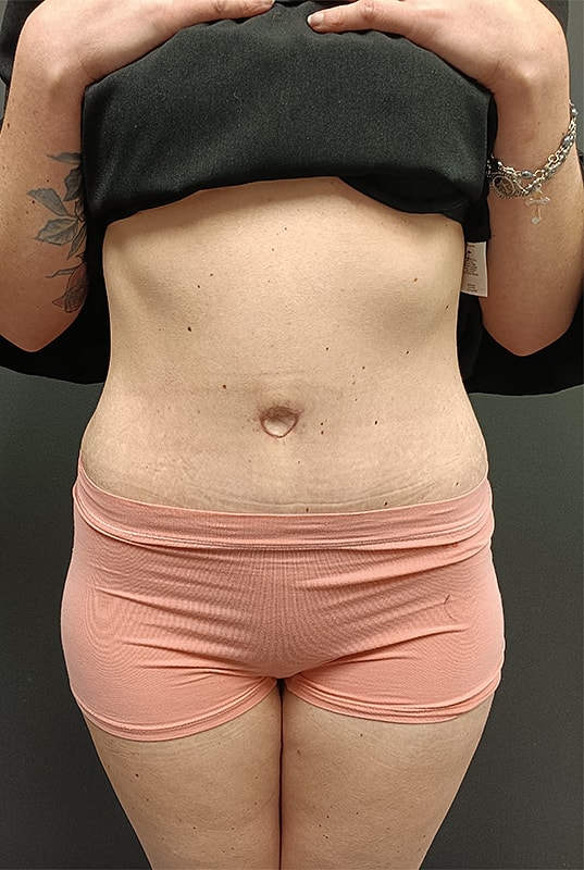 Abdominoplasty Patrick Felice Before & After