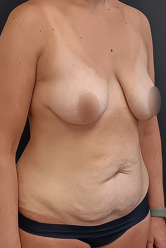 Abdominoplasty Patrick Felice Before & After