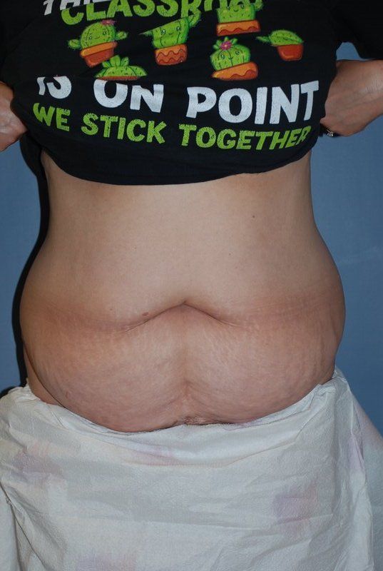 Abdominoplasty Patrick Felice Before & After
