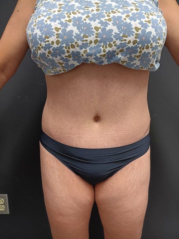 Abdominoplasty Patrick Felice Before & After