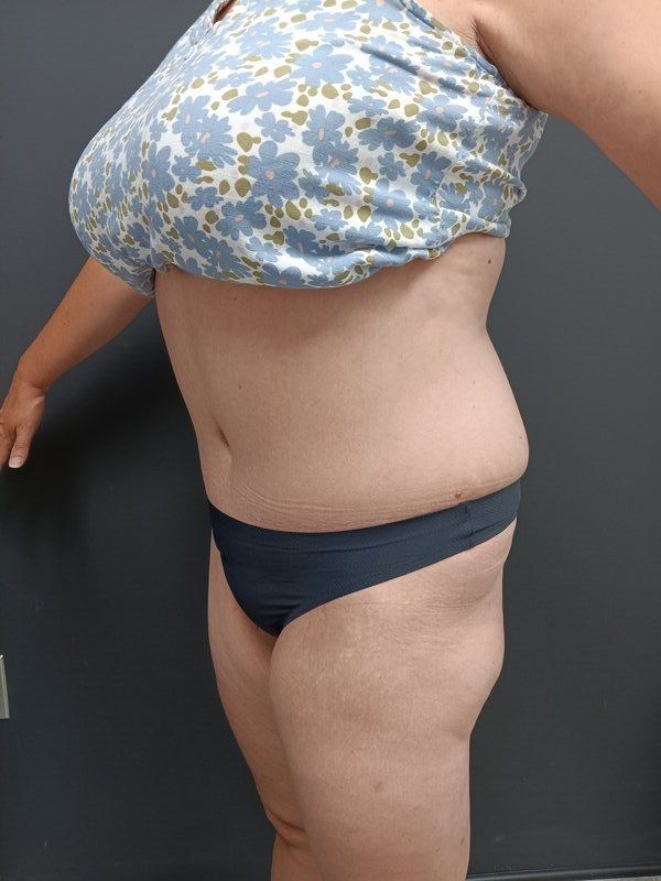 Abdominoplasty Patrick Felice Before & After