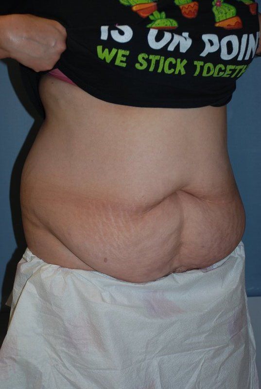 Abdominoplasty Patrick Felice Before & After