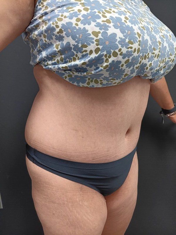 Abdominoplasty Patrick Felice Before & After