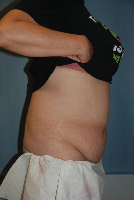 Abdominoplasty Patrick Felice Before & After