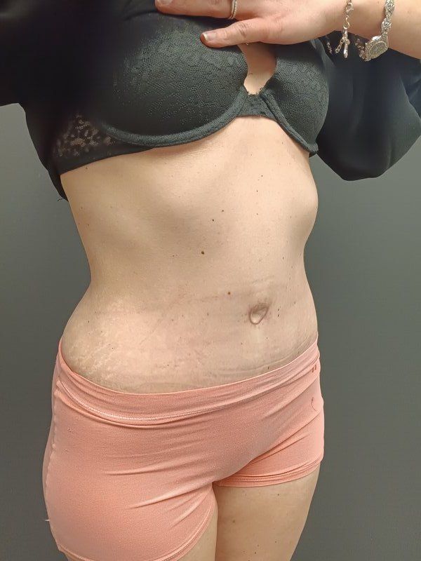 Abdominoplasty Patrick Felice Before & After