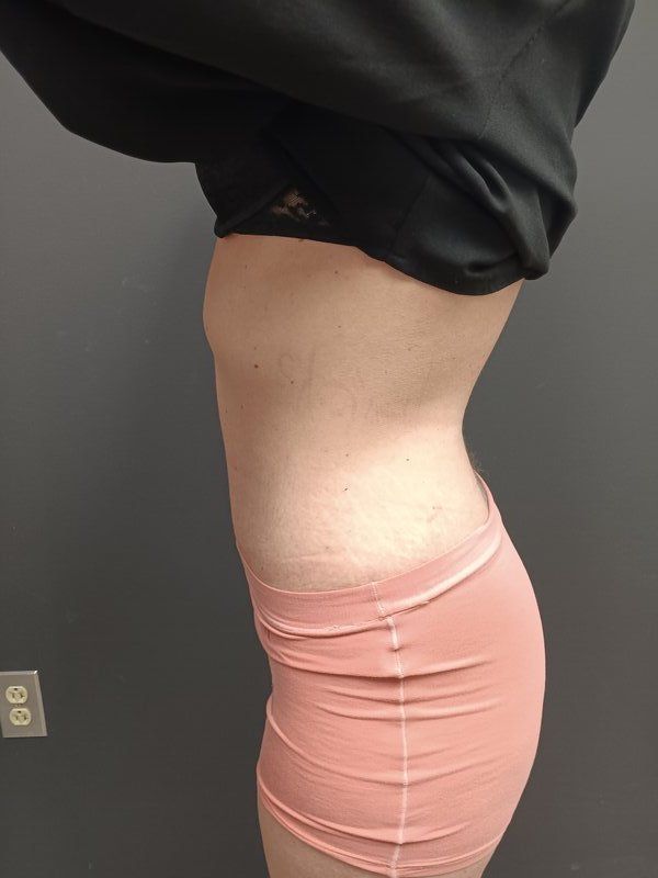 Abdominoplasty Patrick Felice Before & After