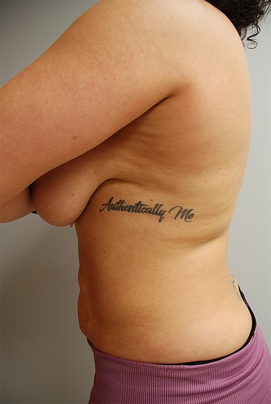 Liposuction Patrick Felice Before & After