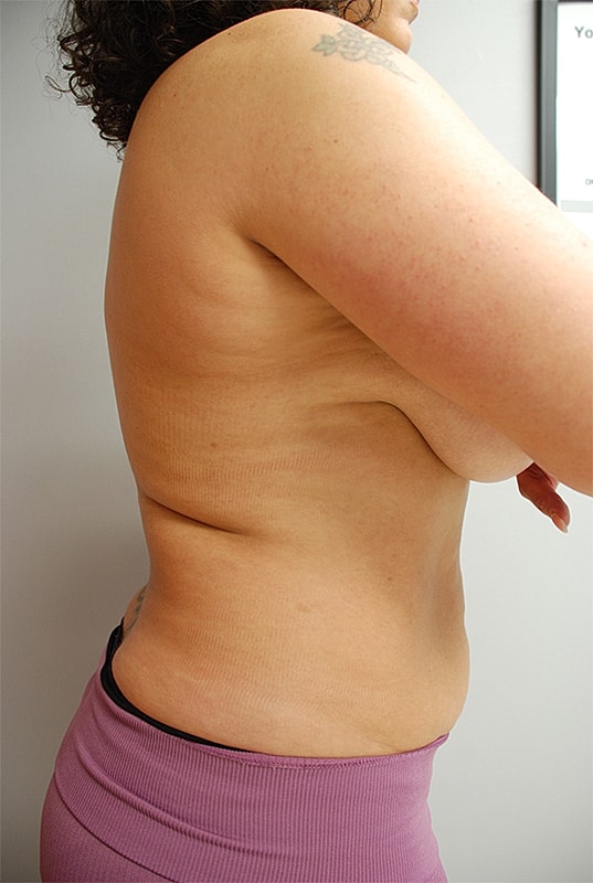 Liposuction Patrick Felice Before & After