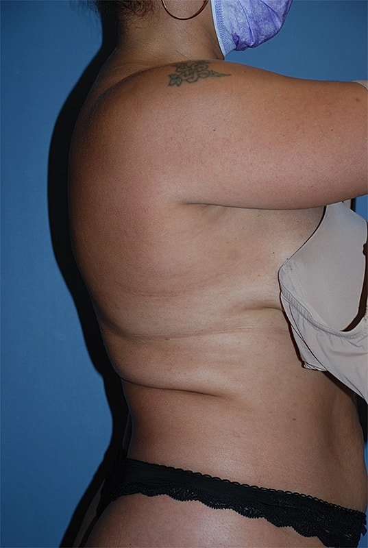 Liposuction Patrick Felice Before & After