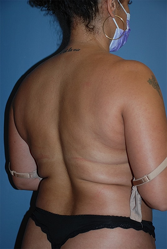 Liposuction Patrick Felice Before & After