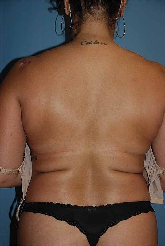 Liposuction Patrick Felice Before & After