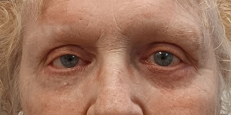 Eyelid Surgery Patrick Felice Before & After