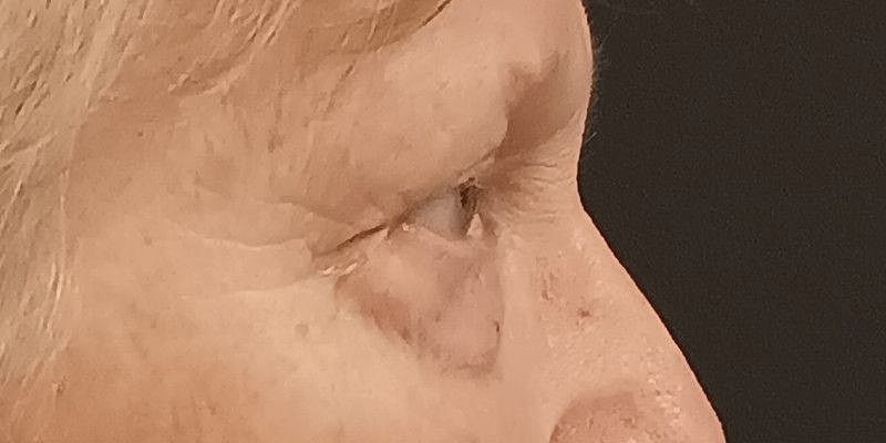 Eyelid Surgery Patrick Felice Before & After
