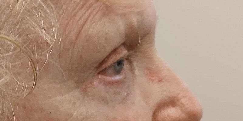 Eyelid Surgery Patrick Felice Before & After