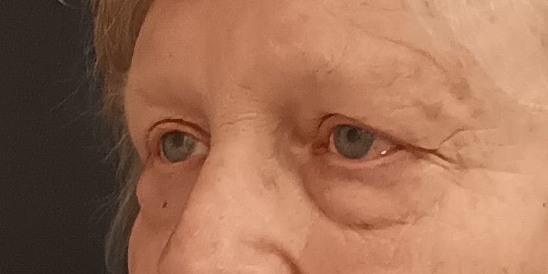 Eyelid Surgery Patrick Felice Before & After