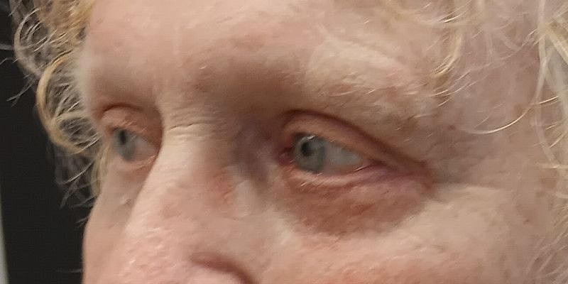 Eyelid Surgery Patrick Felice Before & After