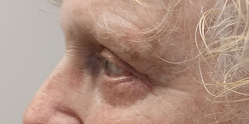 Eyelid Surgery Patrick Felice Before & After