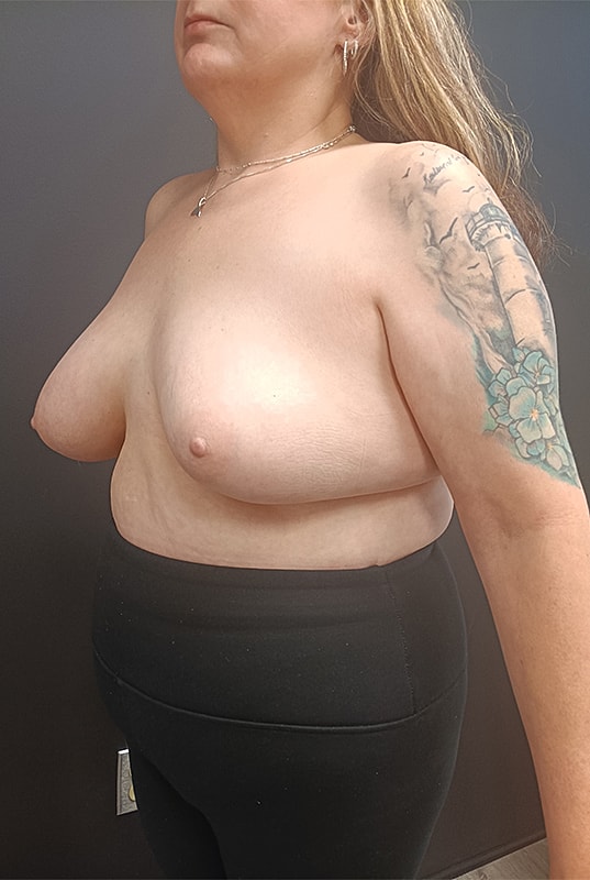 Breast Implant Exchange Patrick Felice Before & After