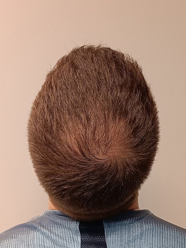 Hair Restoration Before & After