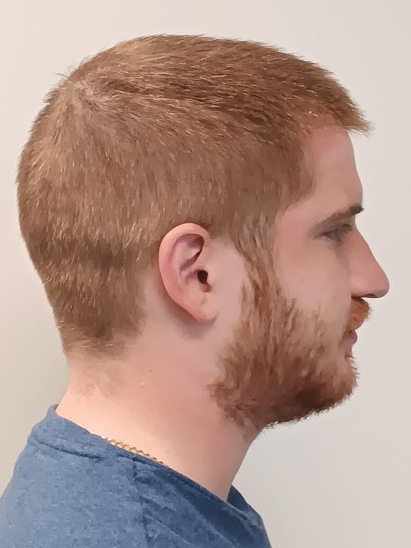 Hair Restoration Before & After