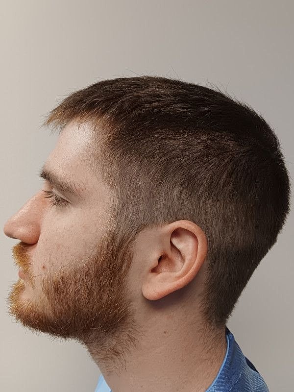Hair Restoration Before & After