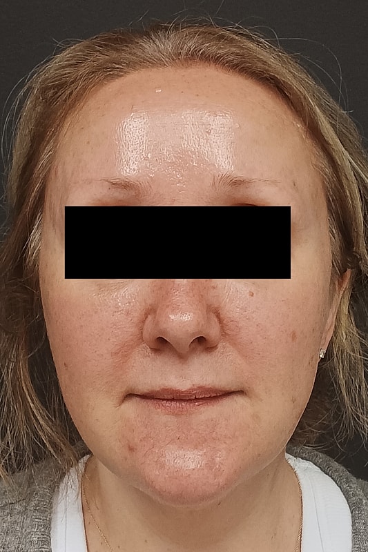 Facelift Patrick Felice Before & After